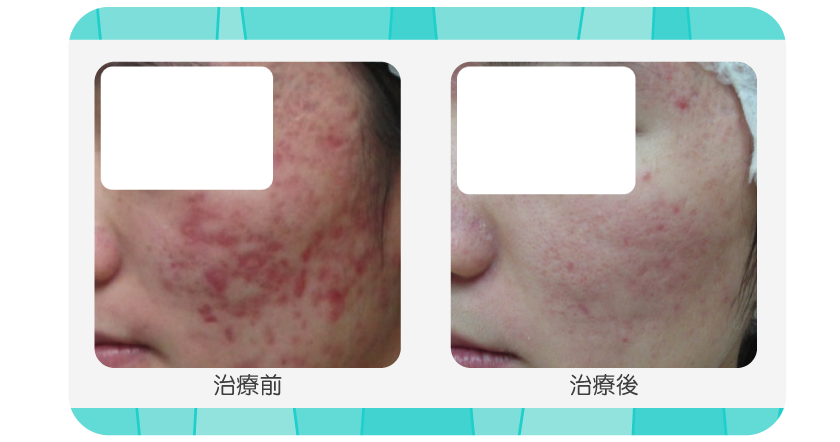 用果酸换肤来改善被痘痘弄得一塌糊涂的皮肤！